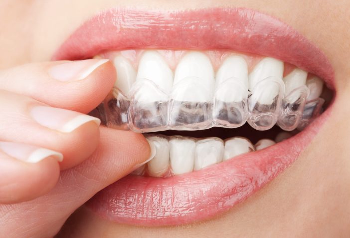 Images of woman placing teeth whitening trays onto her teeth.