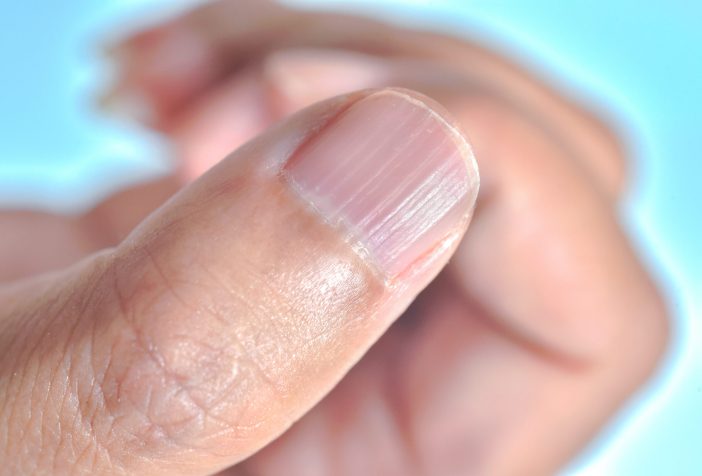 Close-up of a thumb nail with longitudinal ridging.