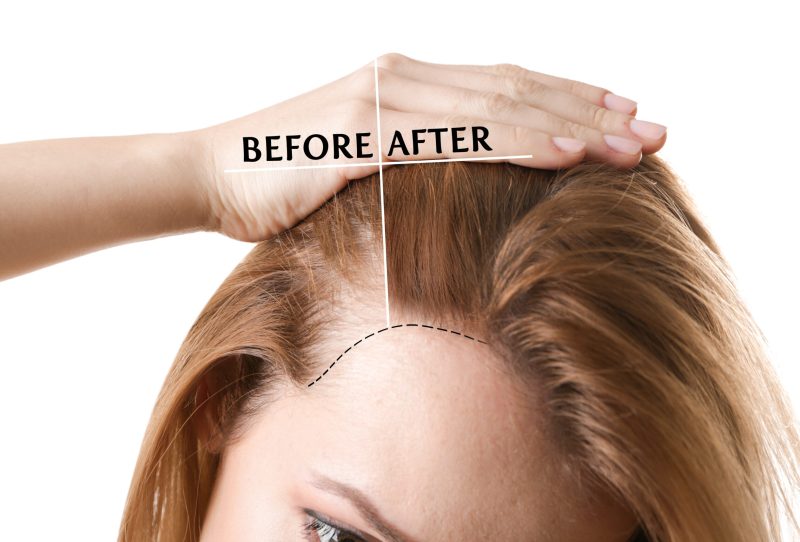 Before and after photo showing a woman with thinning hair and fuller hair.