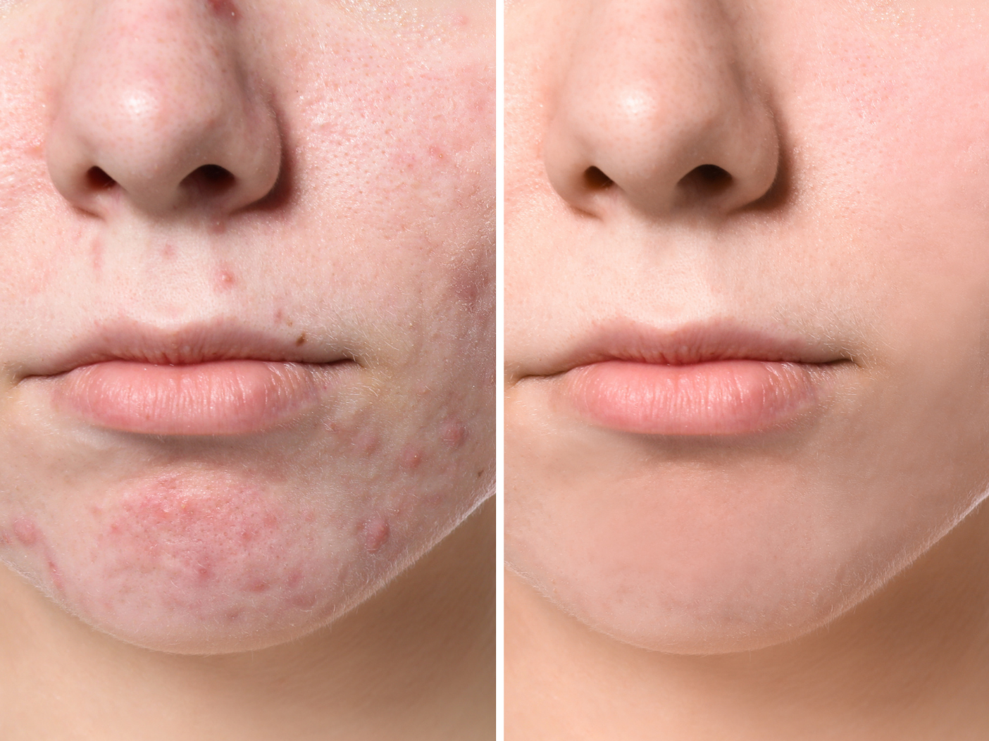 side by side image of woman with acne and clear skin