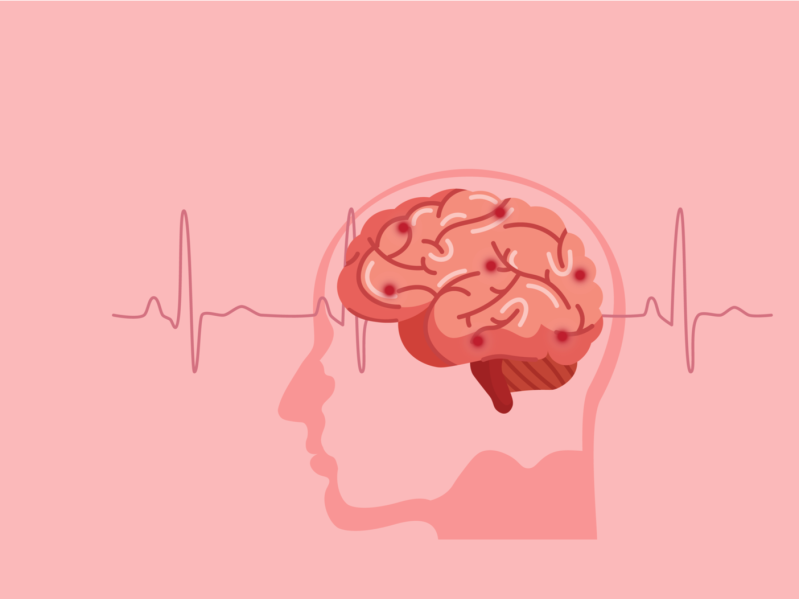 Scientific medical illustration of human brain stroke illustration. Types of human brain stroke illustration