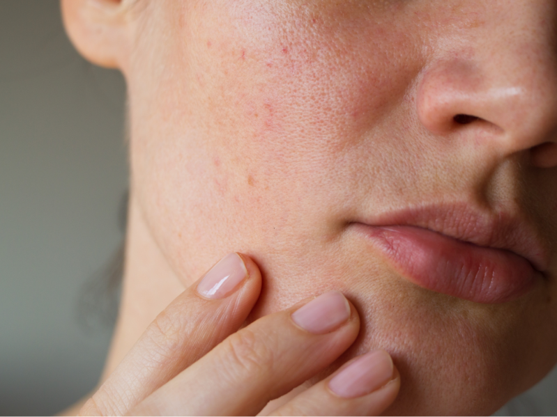 pores on the skin of the face.