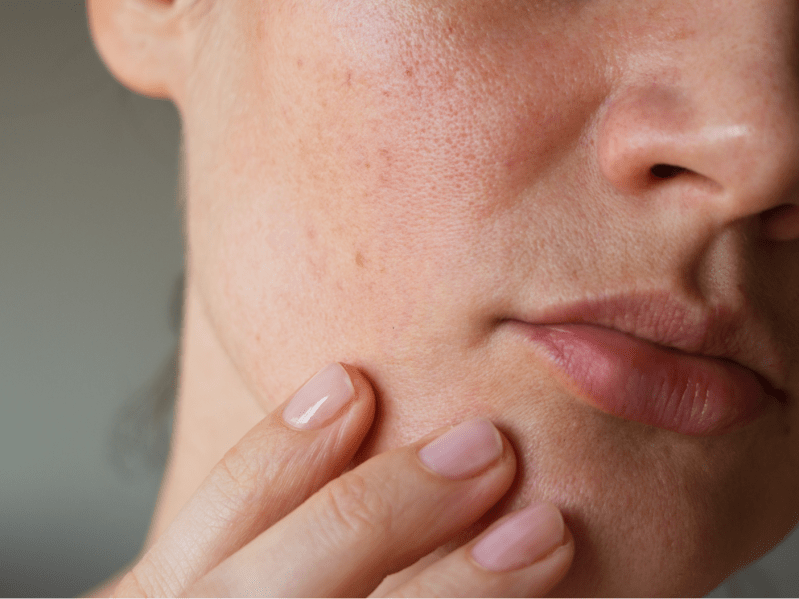 pores on the skin of the face.