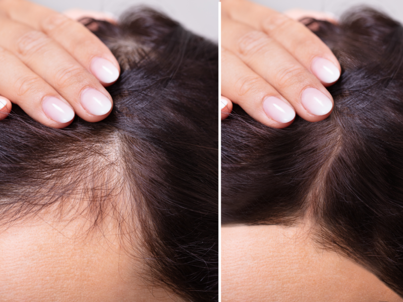Screengrabs of a woman with a receding hairline before and after treatment
