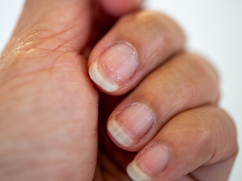 Brittle, peeling nails