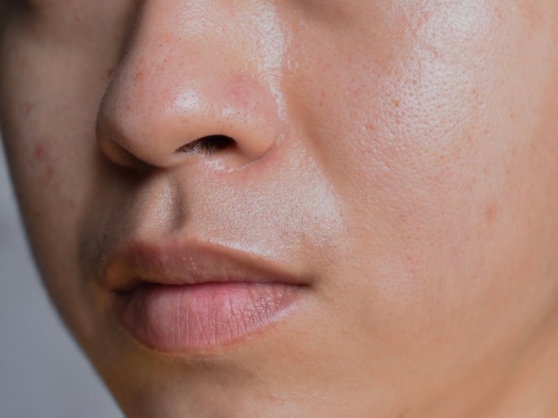 Oily skin with wide pores in face of Southeast Asian, Myanmar or Korean adult young man