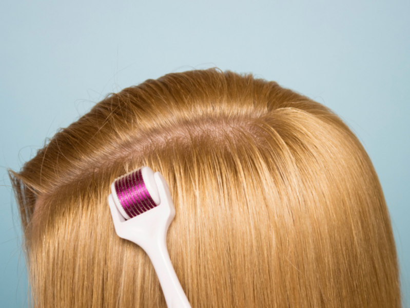 Woman uses dermaroller for hair growth