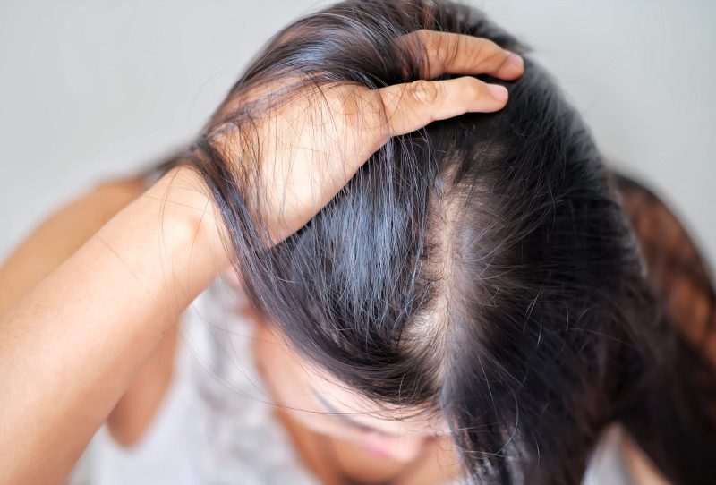 A woman showcasing hair loss along her part line.