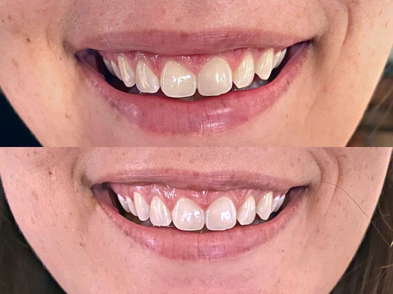 Side by side comparison of teeth stains before and after using MySweetSmile whitening powder