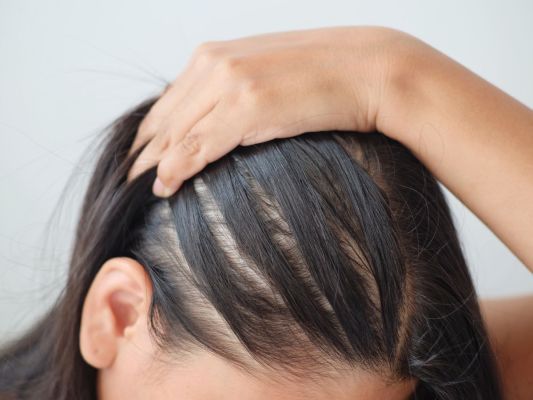 Woman pulling back hair on scalp to reveal thinning