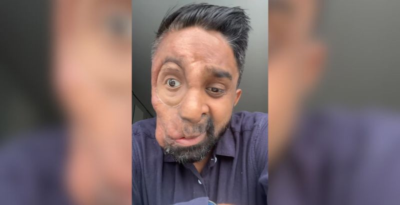 Man With Disfigurement Claims Cafe Refused To Serve Him Because Of His Face