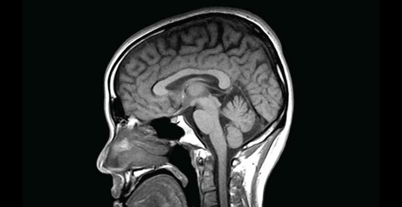 Brain MRI