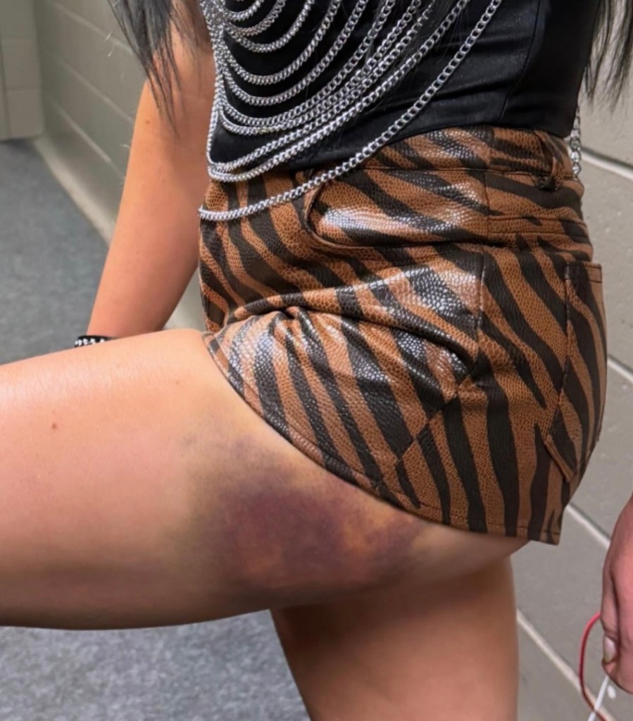 wwe-superstar-reveals-serious-bruise-after-falling-from-ladder