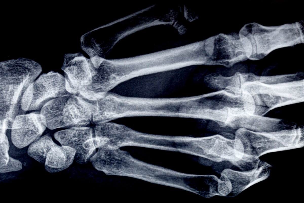 Pulitzer Prize Winner Undergoes Hand Surgery