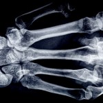 pulitzer-prize-winner-undergoes-hand-surgery