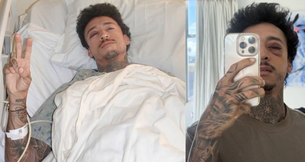 major-pro-skateboarder-fractures-skull-and-eye-socket
