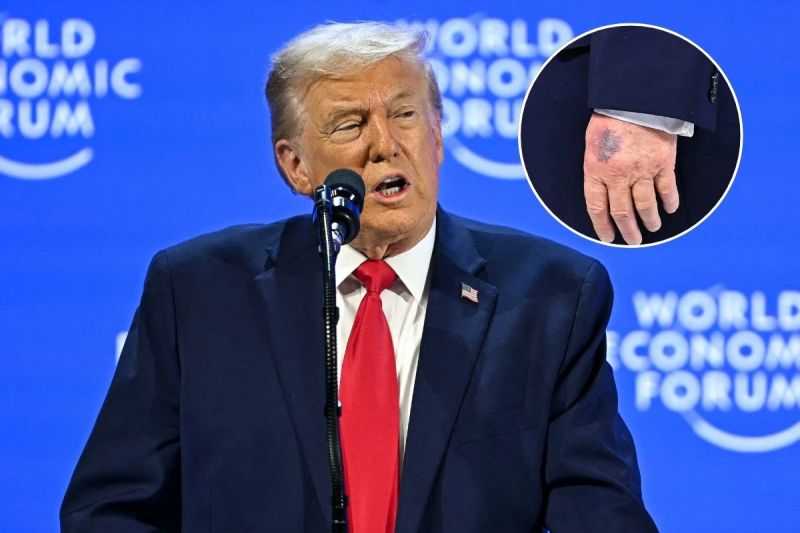 president-trump-responds-to-questions-about-noticeable-bruise-on-left-hand