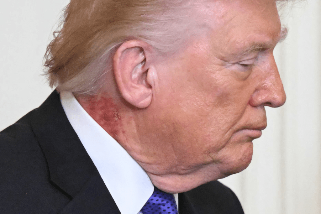 white-house-addresses-mysterious-rash-on-president-trumps-neck